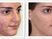 Como Eliminar Acne Naturalmente Prevenir Futuros Brotes