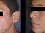 Como Quitar acne Remedios Caseros