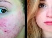 Como Quitar Acne Quistico?