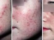 Como Evitar Acne Hormonal