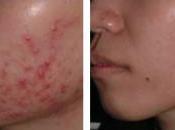 Como Quitar Acne Juvenil