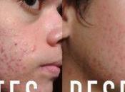 Como Quitar Acne Para Siempre