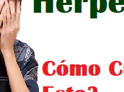 Curar Herpes Medicina Alternativa Remedios Naturales