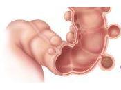 Desarterialización hemorroidal transanal, también conocida como