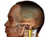 Mielopatía Cervical Degenerativa