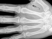 Marca Bestia: Miles suecos implantan microchips bajo piel