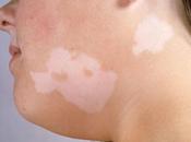 Como Eliminar Manchas Blancas Piel Vitiligo