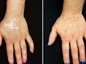 Solución para Vitiligo