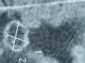 Edema cerebral