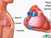 Pericarditis
