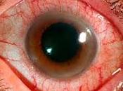 Enfoque Tratamiento para Uveítis infecciosa