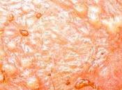 Cómo identificar psoriasis tiña