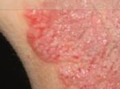 Conocimiento sobre Infecciones Hongos Verdad Detrás Infección