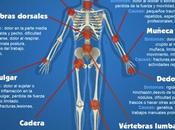 Artricenter: Articulaciones afecta Osteoartrosis