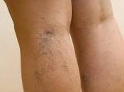 Cual Mejor Tratamiento contra Varices