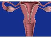 Tratamiento Endometriosis Utilizando Bioingeniería