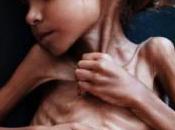 Murió Amal Hussain, niña símbolo hambruna Yemen cinismo Primer Mundo