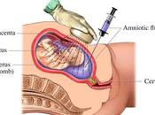 Amniocentesis: indicaciones contraindicaciones