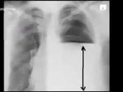 Aprende interpretar radiografía tórax