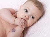 Cuando Tratar Hemangiomas Infantiles