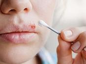 Herpes labial: ¿Qué Cuáles síntomas cómo evitarlo?