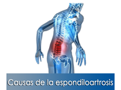 Artricenter: Causas espondiloartrosis