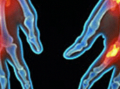 Artritis Reumatoide, tratamiento oportuno evita lamentables desenlaces