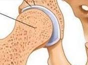 Realizan éxito primer trasplante mundial cartílago cadera