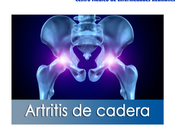 Artricenter: Artritis cadera
