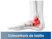 Artricenter: Osteoartrosis tobillo