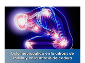 Artricenter: Dolor neuropático artrosis rodilla cadera