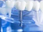 Implantes dentales, etapas colocación.