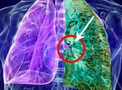 Enfermedad pulmonar intersticial