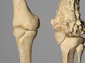 osteosarcoma cáncer afecta niños adultos