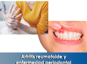 Artricenter: Artritis reumatoide enfermedad periodontal.