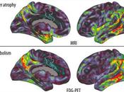 Alzheimer Puede Área Cerebro Guarda Música