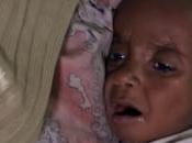 FAO: hambre mundo lleva tres años disminuir