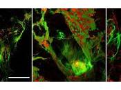 Células Inmunes conducen formación Cálculos Biliares