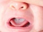 Candidiasis: infección boca bebés niños
