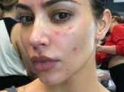 Kardashian mostró fotos piel afectada psoriasis