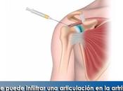 Artricenter: puede infiltrar articulación artritis reumatoide?