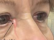 #Salud: ciento población joven #México padece Seco