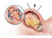 Beneficios Cirugía Prenatal para Espina Bífida