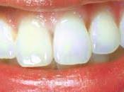 sonrisa bella Philips Sonycare