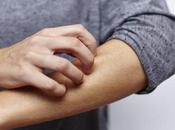 Remedios caseros para psoriasis