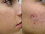 Como eliminar manchas acné