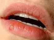 Herpes labios