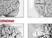 Posible nueva para tratar enfermedad Alzheimer