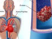 Tratamiento embolia pulmonar