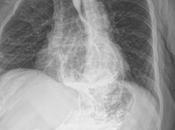 Hernia hiatal deslizante paraesofagica